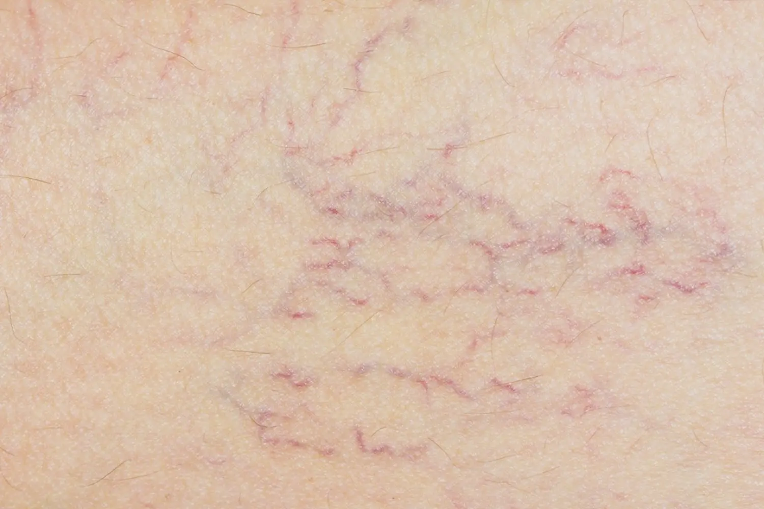 Besenreiser, Blutgefäße und Rosacea von Gynpraxis Mitte