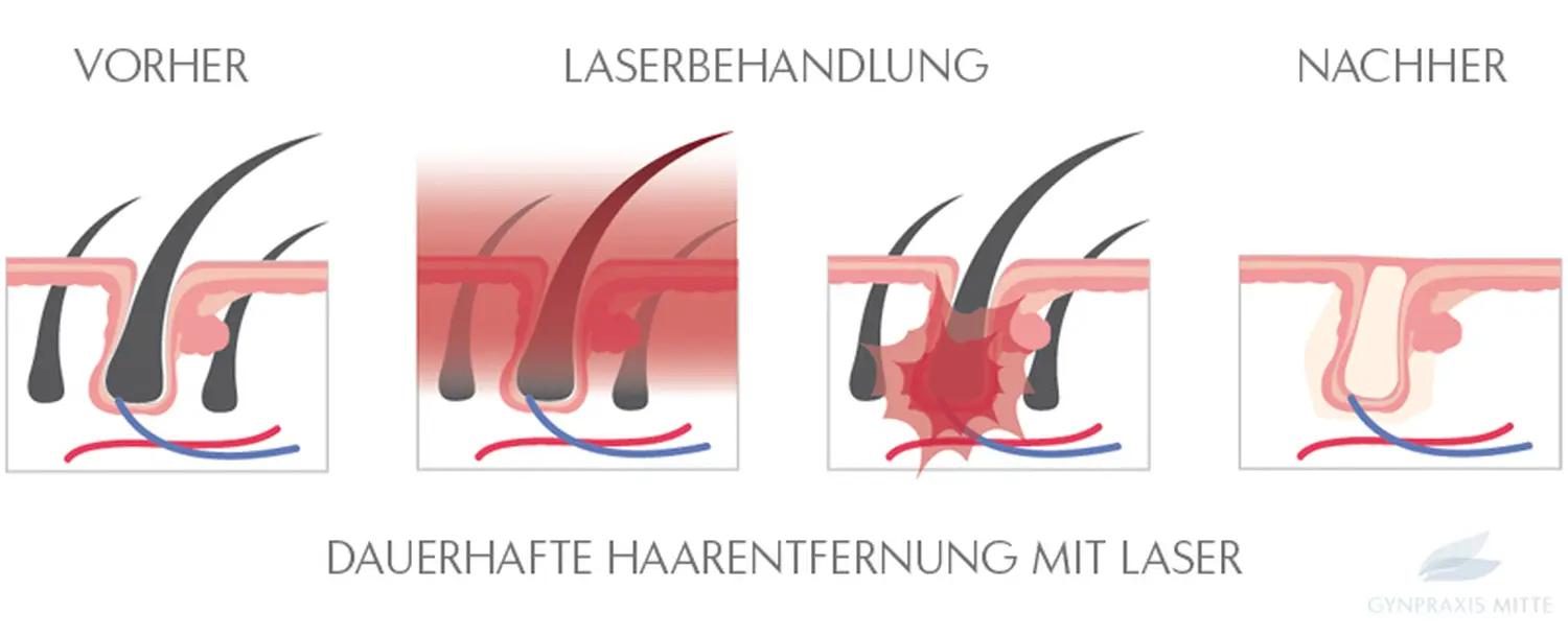 Laserbehandlungen von Gynpraxis Mitte